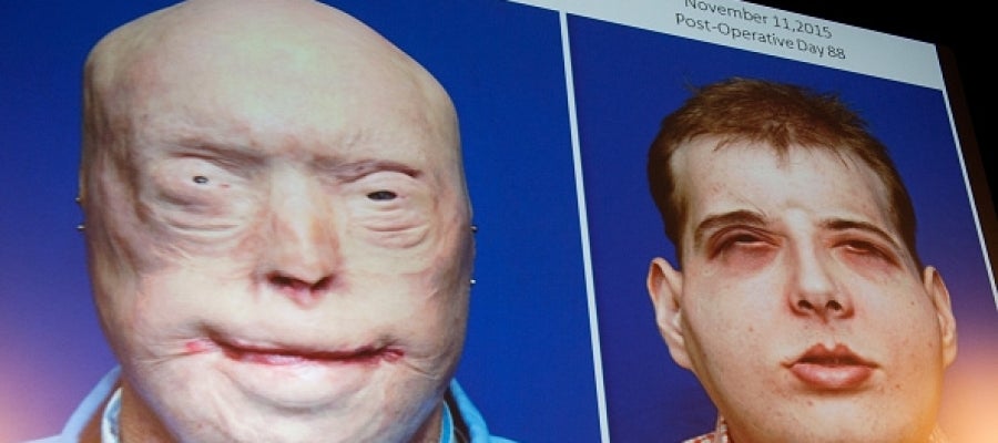 Imagen del paciente antes y después del trasplante de cara Imagen del paciente antes y después del trasplante de cara