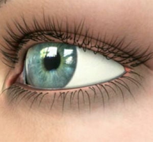 Glaucoma Glaucoma
