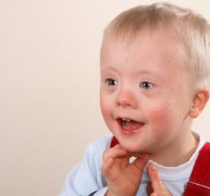 Niño con síndrome de down Niño con síndrome de down
