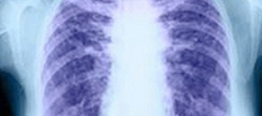 El cáncer de pulmón El cáncer de pulmón