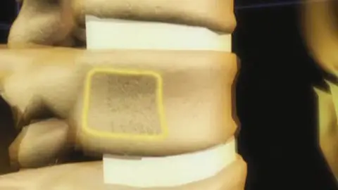 Osteoporosis Osteoporosis