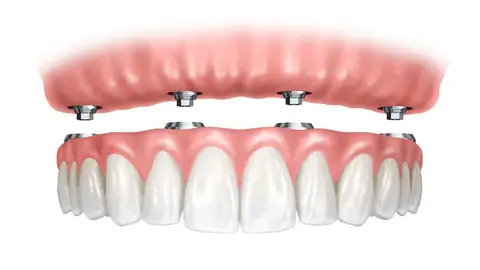 Dentadura postiza Dentadura postiza