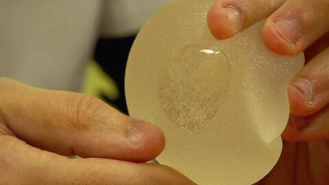 Un m&eacute;dico muestra una pr&oacute;tesis mamaria