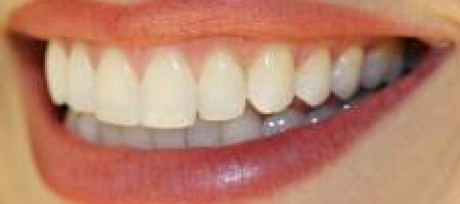 dientes blancos dientes blancos