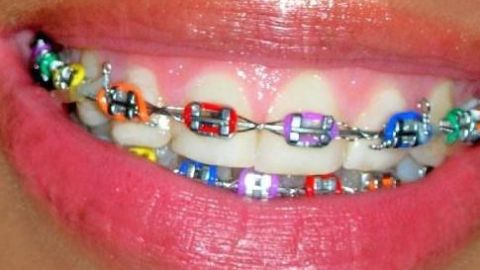 Braquets
