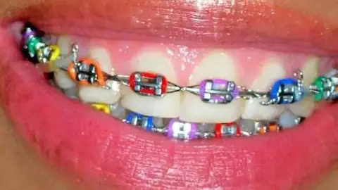 Braquets Braquets
