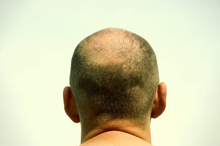 ¿El fin de la alopecia? Un estudio sostiene que se puede hacer que crezca nuevo pelo ¿El fin de la alopecia? Un estudio sostiene que se puede hacer que crezca nuevo pelo