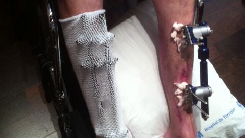 Paciente tras operaci&oacute;n de reimplante de piernas