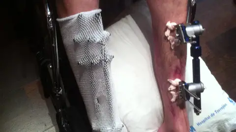 Paciente tras operación de reimplante de piernas Paciente tras operación de reimplante de piernas