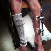Paciente tras operación de reimplante de piernas