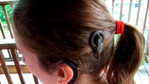 Implante coclear Implante coclear