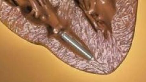 El primer marcapasos sin cables del mundo