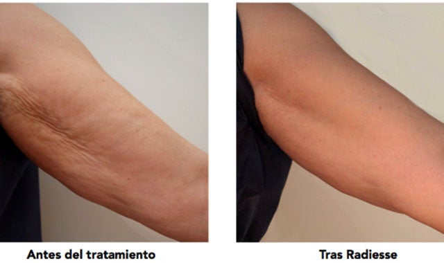 30ytantos: Brazos sin colgajos 30ytantos: Brazos sin colgajos