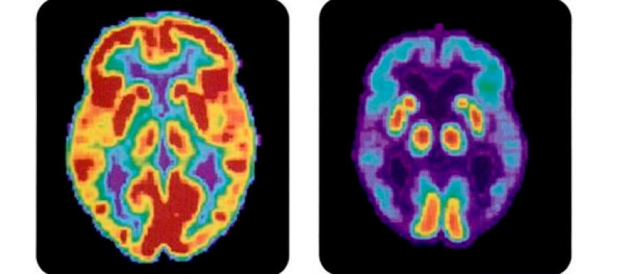 Alzheimer Alzheimer