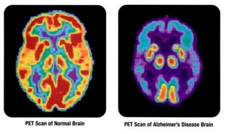 Alzheimer