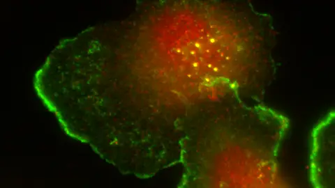 Células tumorales humanas de cáncer de m Células tumorales humanas de cáncer de m