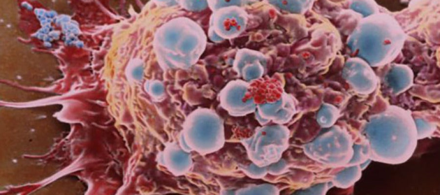 Célula cancerosa Célula cancerosa