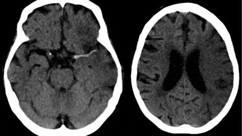 Ictus en arteria cerebral media (izda) y evoluci&oacute;n a las 7 horas (dcha). 