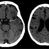 Ictus en arteria cerebral media (izda) y evolución a las 7 horas (dcha). 