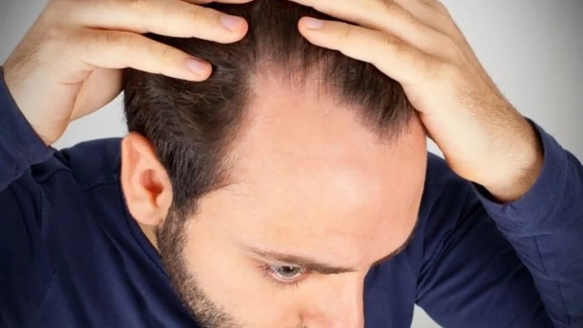 Caída del cabello Caída del cabello