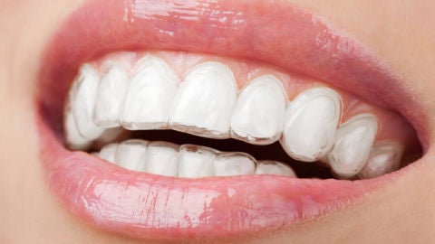Dientes con funda transparente
