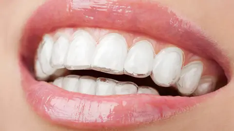 Dientes con funda transparente Dientes con funda transparente