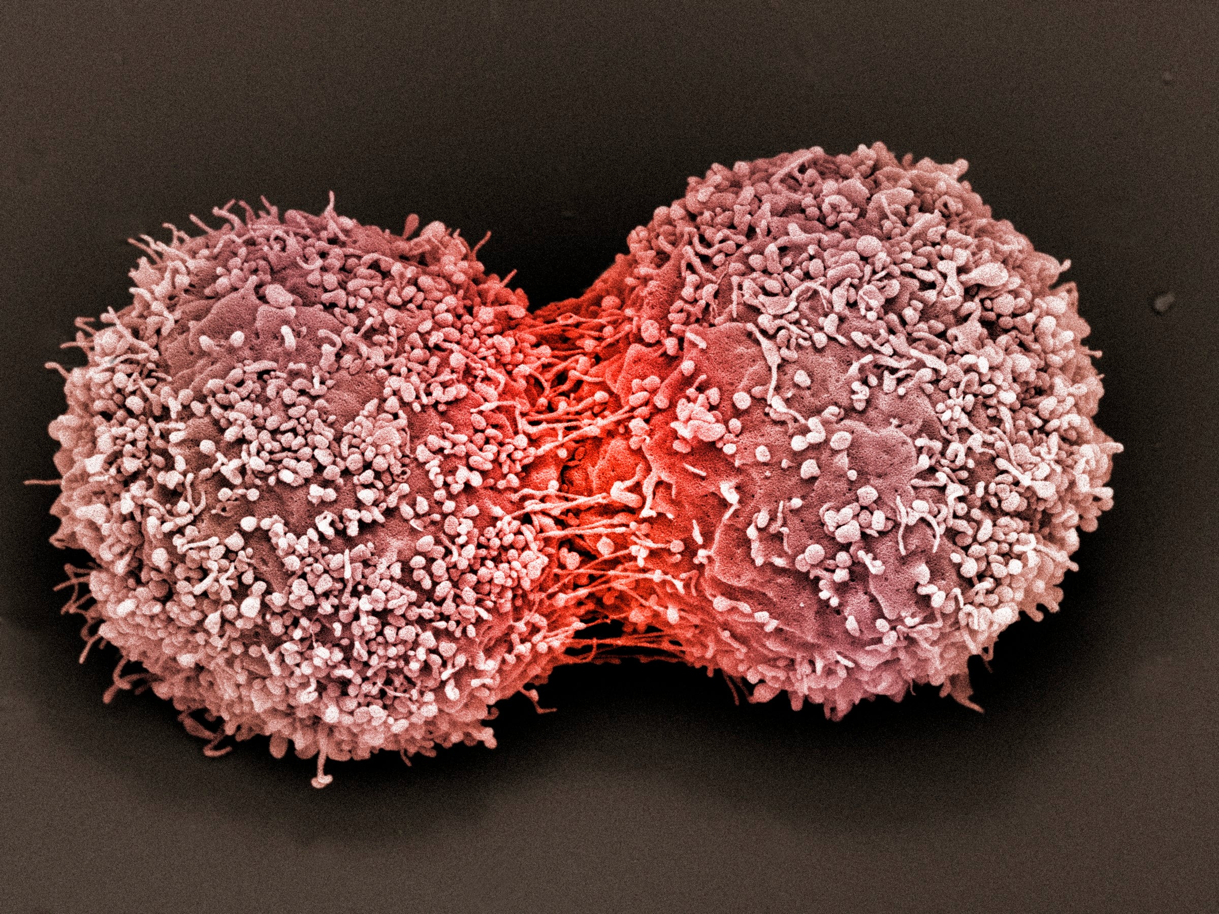 Crean nanopartículas que reprograman las células inmunes para combatir el cáncer Crean nanopartículas que reprograman las células inmunes para combatir el cáncer