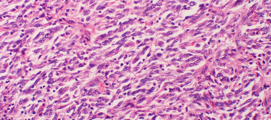 Muestra celular de melanoma con metástas Muestra celular de melanoma con metástas