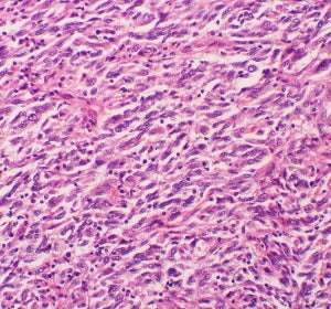 Muestra celular de melanoma con metástas Muestra celular de melanoma con metástas