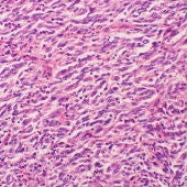 Muestra celular de melanoma con metástas
