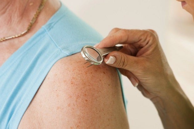 Crean un algoritmo que diagnostica el cáncer de piel con la misma precisión que los dermatólogos Crean un algoritmo que diagnostica el cáncer de piel con la misma precisión que los dermatólogos