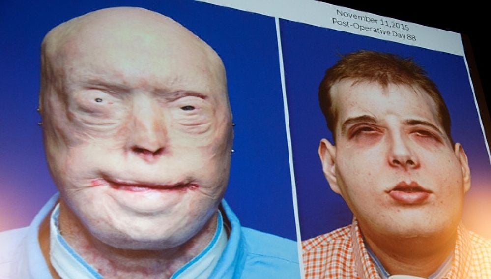 Imagen del paciente antes y después del trasplante de cara
