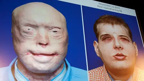 Imagen del paciente antes y después del trasplante de cara Imagen del paciente antes y después del trasplante de cara