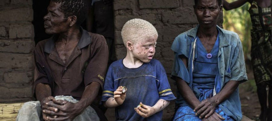 Los niños albinos son perseguidos por la superstición y la magia negra Los niños albinos son perseguidos por la superstición y la magia negra