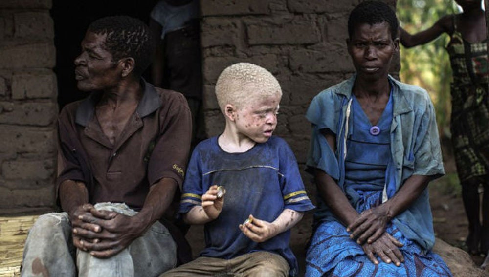 Los niños albinos son perseguidos por la superstición y la magia negra