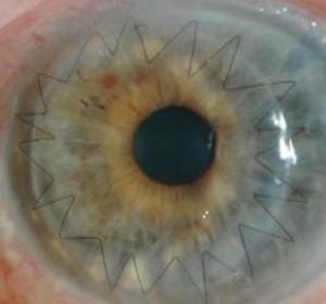 Imagen de un ojo después de un trasplante de córnea Imagen de un ojo después de un trasplante de córnea