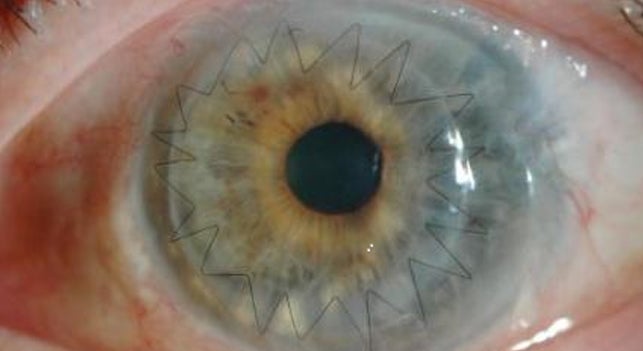 Un oftalmólogo logra 'Cum Laude' con su tesis sobre la calidad en trasplantes corneales Un oftalmólogo logra 'Cum Laude' con su tesis sobre la calidad en trasplantes corneales