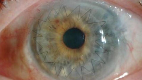 Imagen de un ojo despu&eacute;s de un trasplante de c&oacute;rnea