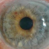 Imagen de un ojo después de un trasplante de córnea