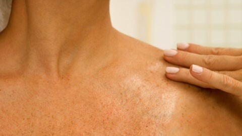 La lucha contra el c&aacute;ncer de piel