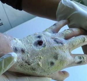 Los graves efectos que produce el consumo de 'Krokodil', una peligrosa nueva droga Los graves efectos que produce el consumo de 'Krokodil', una peligrosa nueva droga