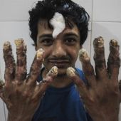 El 'hombre árbol' de Bangladesh tras una operación