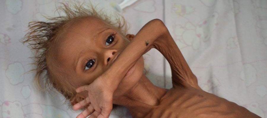 Un niño yemení desnutrido Un niño yemení desnutrido