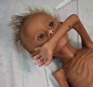 Un niño yemení desnutrido Un niño yemení desnutrido