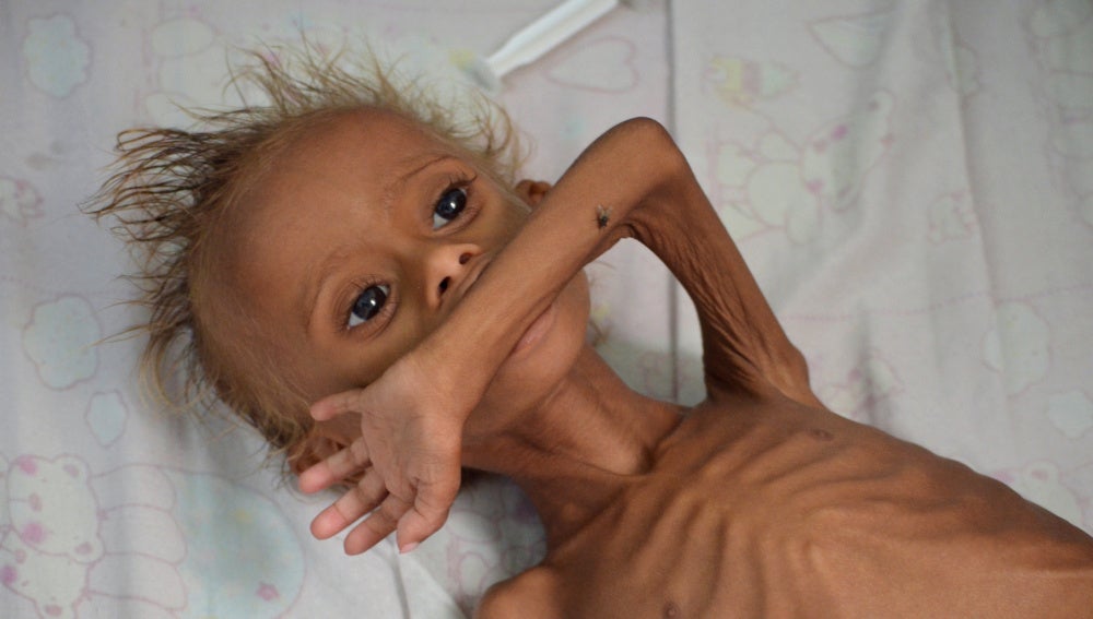 Un niño yemení desnutrido