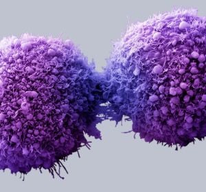 Células de páncreas cancerosas completando la división celular - Getty Images/Visuals Unlimited Células de páncreas cancerosas completando la división celular - Getty Images/Visuals Unlimited