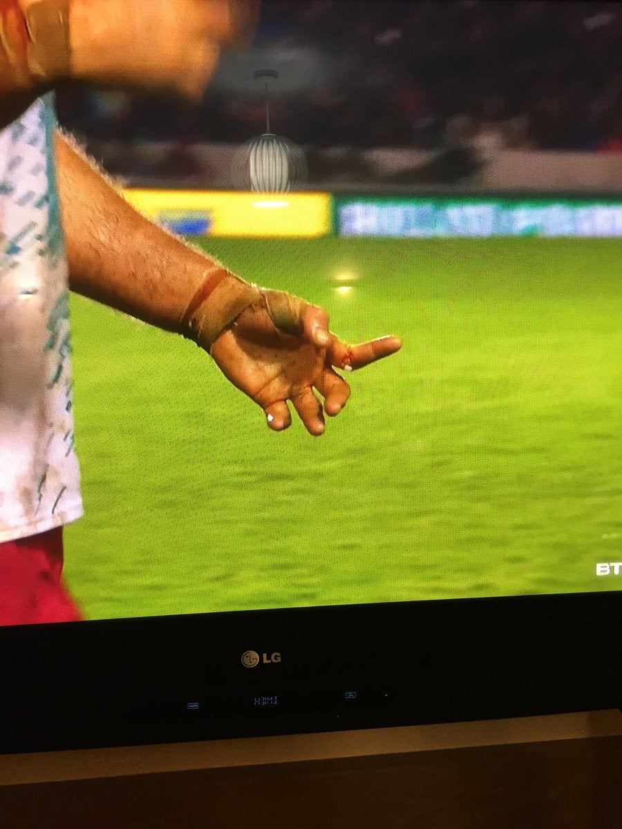 Un jugador de los Harlequins se hace una escalofriante lesión en el dedo y sigue jugando hasta el final de partido Un jugador de los Harlequins se hace una escalofriante lesión en el dedo y sigue jugando hasta el final de partido