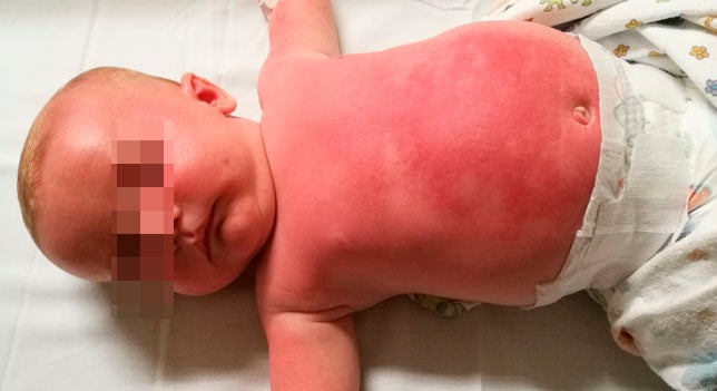 Hospitalizado un bebé tras usar una crema protectora de Peppa Pig Hospitalizado un bebé tras usar una crema protectora de Peppa Pig