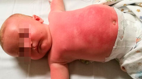 Beb&eacute; hospitalizado tras usar una crema protectora