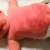 Bebé hospitalizado tras usar una crema protectora